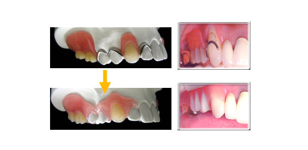 審美的に優れた入れ歯