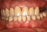 審美的に優れた入れ歯