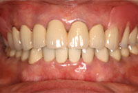 審美的に優れた入れ歯