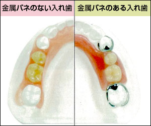 審美的に優れた入れ歯