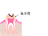 虫歯の進み方