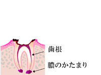 虫歯の進み方