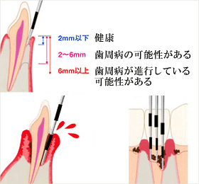 歯周ポケットの測定