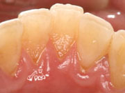 歯周病の症例