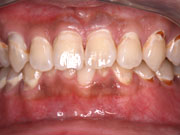 歯周病の症例