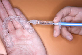 ホームホワイトニング