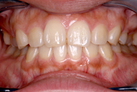 ホームホワイトニング