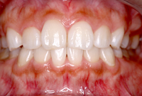 ホームホワイトニング