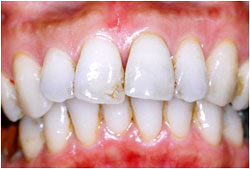 ホームホワイトニング