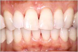 ホームホワイトニング