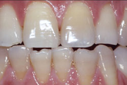 ホームホワイトニング